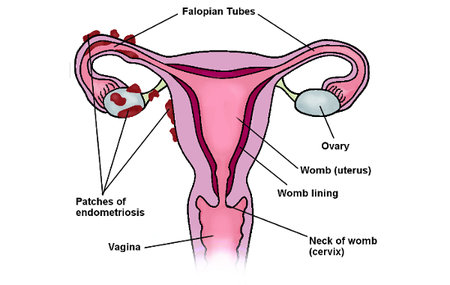 What is Endometriosis ?